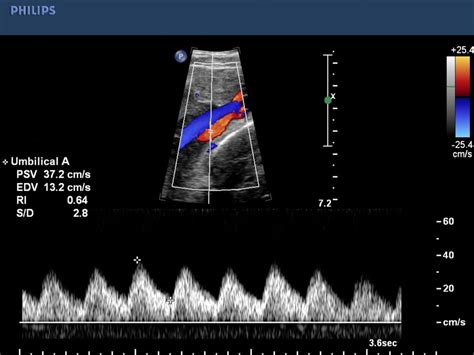 Umbilical Artery Doppler Chart