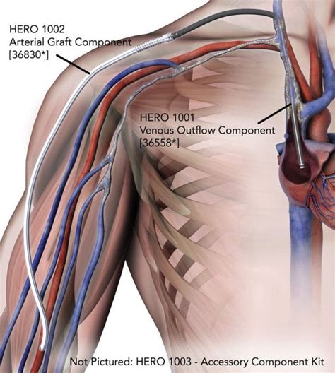 What is HeRO Graft? - Merit Medical