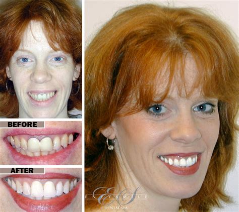 Gum Disease in Brooklyn, NY | Gingivitis Treatment