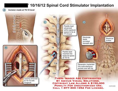 Spinal Cord Stimulator Implantation