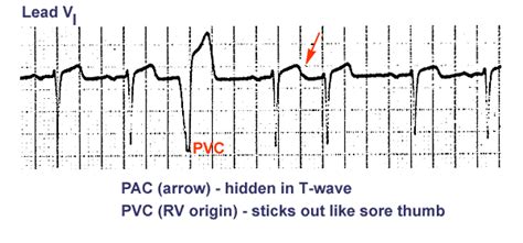 ECG: Cardiac Rhythms