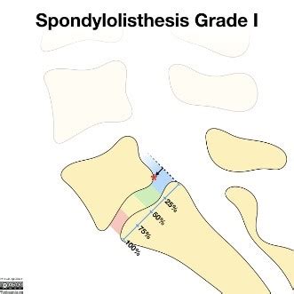 Spondylolisthesis - Physiopedia