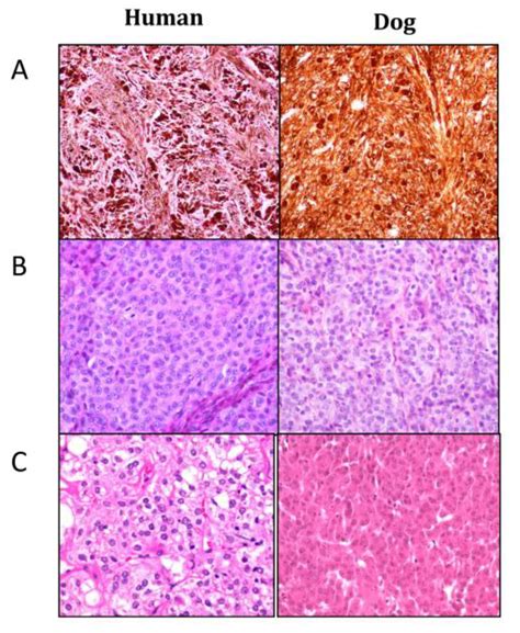 Invasive Melanoma Histology