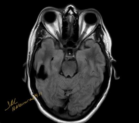 Neuroglial cyst - NeuroRad911