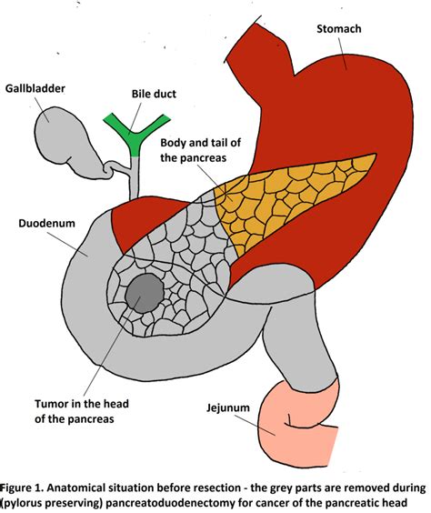 The Pancreatic Anastomosis – An Overview of Different Anastomosis Techniques