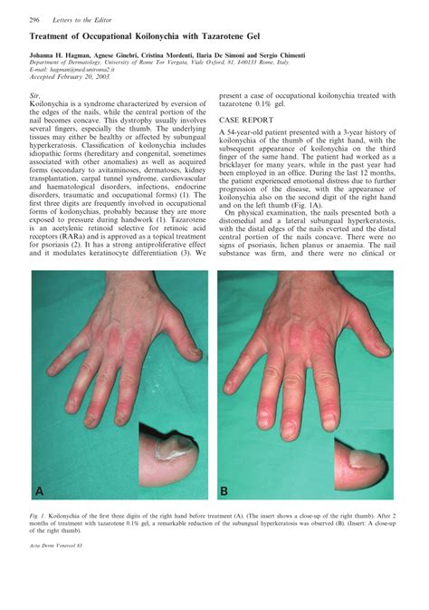 (PDF) Treatment of Occupational Koilonychia with Tazarotene Gel