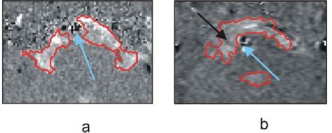 5 (a) Automatically segmented pontine cistern. (b) The observer... | Download Scientific Diagram