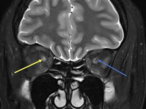 Optic Neuritis (ON) - MRI Online