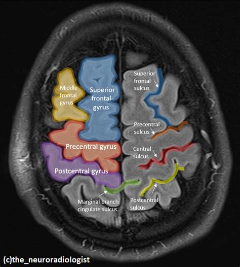 Mri Paracentral Lobule