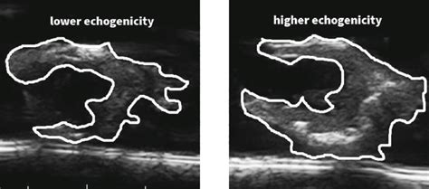 Lower and higher echogenicity grade of two different plaques | Download ...