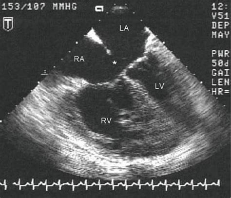 Atrioventricular Septal Defect Ultrasound