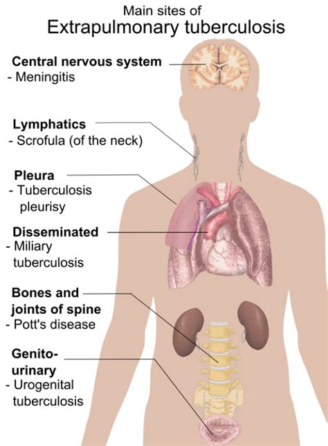 Tuberculosis (TB) | Symptoms, Signs, Management | Geeky Medics