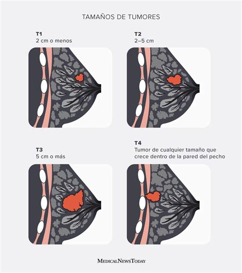 Etapas Del Cancer