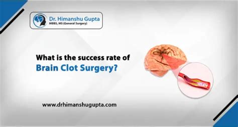 What is the Success Rate of Brain Clot Surgery in 2022