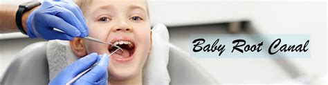 Baby Root Canal - Ideal Smile Dentist