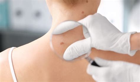 Promise for metastatic melanoma treatment | CredoWeb