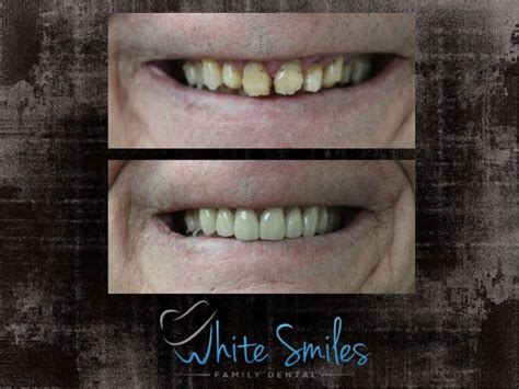 Beautiful Smiles Before & After. White Smiles Family Dental | by White Smiles Family Dental | Medium