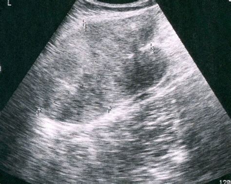 Ultrasound image showing a large mass of heterogeneous echogenicity ...