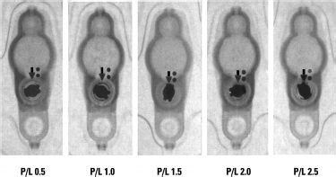 Determining Settings of Programmable VP Shunts | UW Emergency Radiology