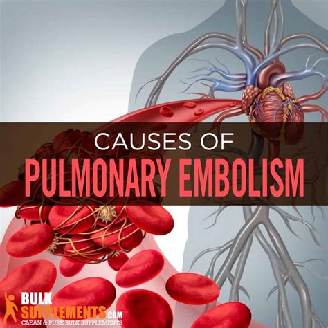 Pulmonary Embolism: Causes, Symptoms & Treatment