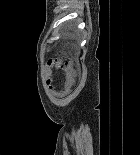 Caput medusae (Radiopaedia 60632-68360 B) - NC Commons