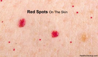 What causes red spots on the skin | How to get rid of the red spots on skin