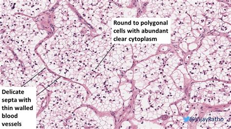 RENAL CELL CARCINOMA- CLEAR CELL TYPE - Pathology Made Simple