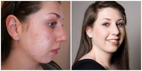 Makeup Before And After Acne - Mugeek Vidalondon