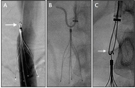 Endovascular Today - Current IVC Filter Retrieval Techniques (July 2017)