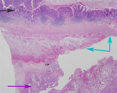 Vernix caseosa peritonitis – no longer rare or innocent: a case series | Journal of Medical Case ...