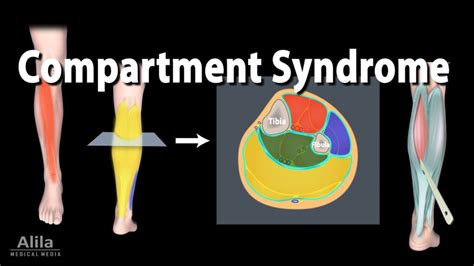 Compartment Syndrome - Motus Physical Therapy