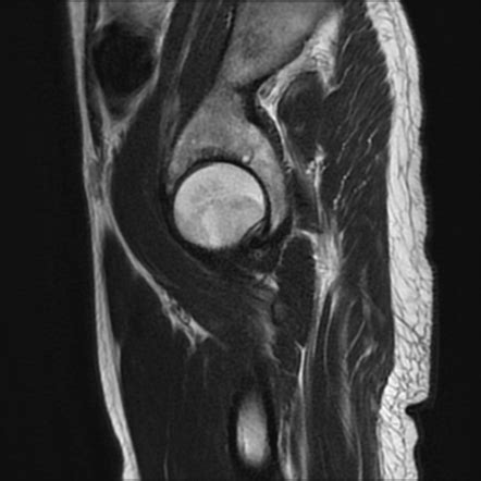 Seronegative spondyloarthritis | Image | Radiopaedia.org