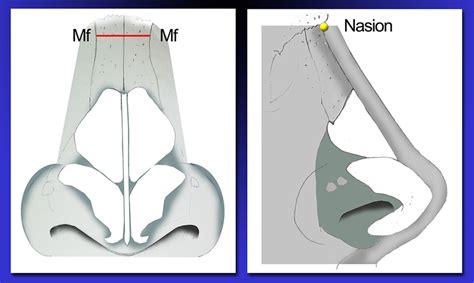 External anatomy of the nasal root and its measurements. Nasal root ...