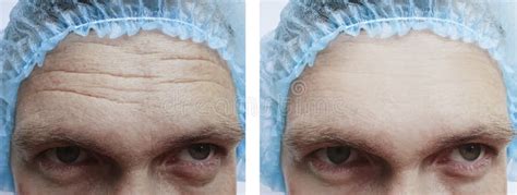 Male Forehead Wrinkles before and after Treatment Stock Photo - Image of filler, lifting: 143805848