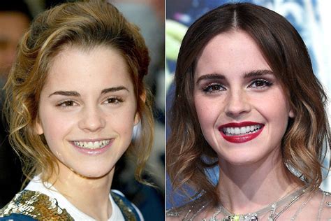 Celebrity Teeth Before & After: Teeth Whitening Makeovers Pictures 2017 | Glamour UK