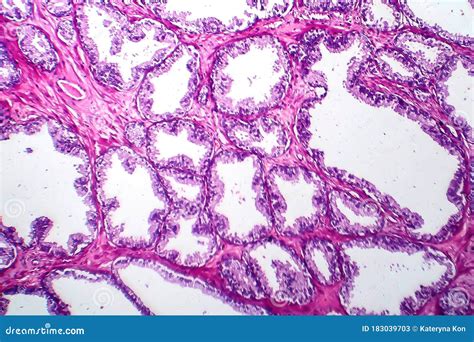 Prostate Cancer, Light Micrograph Stock Image - Image of neoplasm, tissue: 183039703