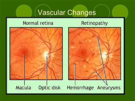 Hypertensive Retinopathy