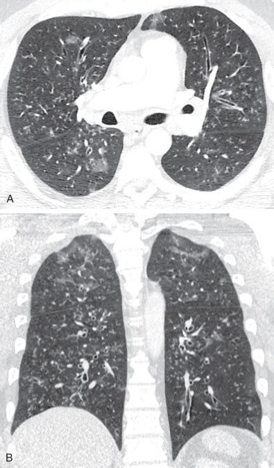 Bronchiolitis | Radiology Key