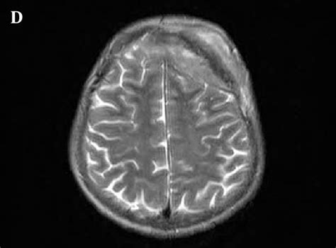 Axial CT scan (A,B), a calvarial lesion with both extra-and ...