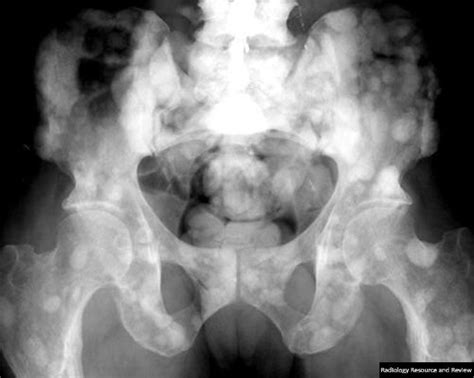 Learning Radiology - Metastatic, Disease, Bone