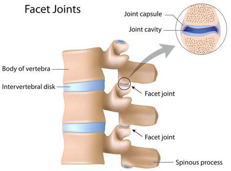 Lumbar facet syndrome causes, symptoms, diagnosis, treatment & prognosis