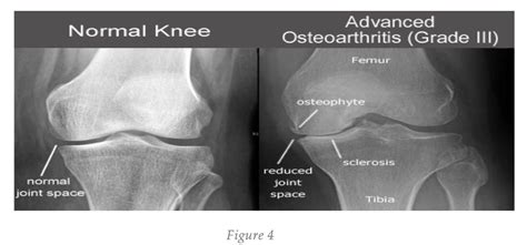 Osteoarthritis X Rays