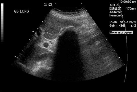 Porcelain gallbladder - wikidoc