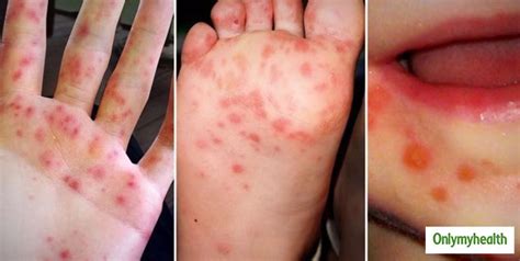 Hand, Foot And Mouth Disease: Symptoms, Causes And Care Tips | OnlyMyHealth