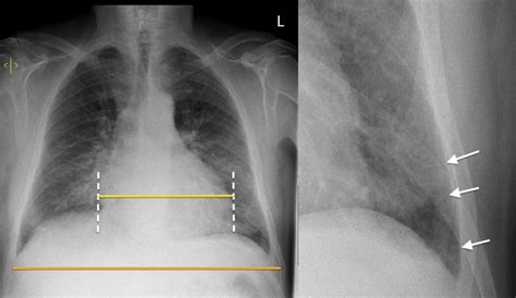 Congestive cardiac failure - Radiology at St. Vincent's University Hospital