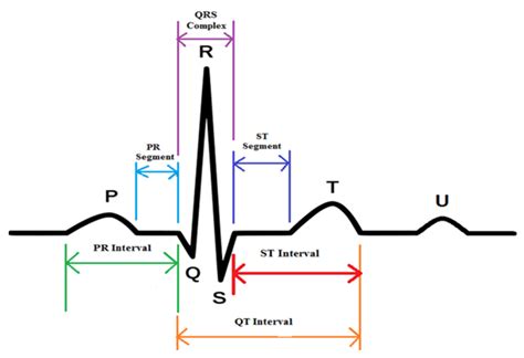 ECG Wave Diagram