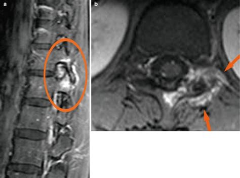 Psoriatic Arthritis | Radiology Key