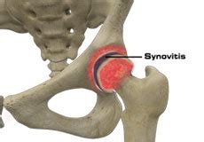 Hip Synovitis Houston | Hip Pain Pearland | Hip Infection Pearland