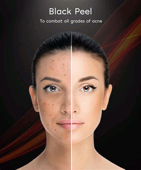 Anti acne treatment Lucknow | Scar Treatment