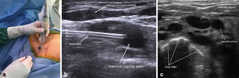 Ultrasound-Guided Vascular Access | Radiology Key